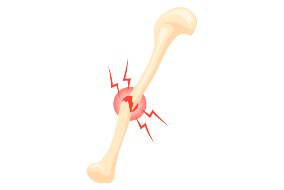 Review: Broken Bone Icon for Embroidery Projects